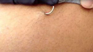 How to Remove a Fishing Hook from Skin